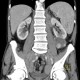 Renal carcinoma, cystic, retroperitoneal lymphadenopathy: CT - Computed tomography